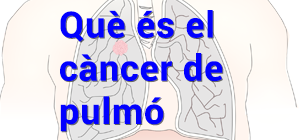 Què és el càncer de pulmó