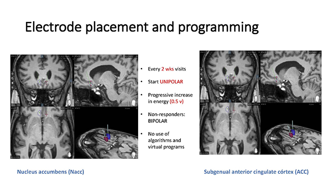 Investigadors de Sant Pau i FIDMAG, adscrits al CIBERSAM, realitzen el primer estudi al món en el que s’aplica l’estimulació cerebral profunda (DBS) a pacients amb esquizofrènia resistent al tractament